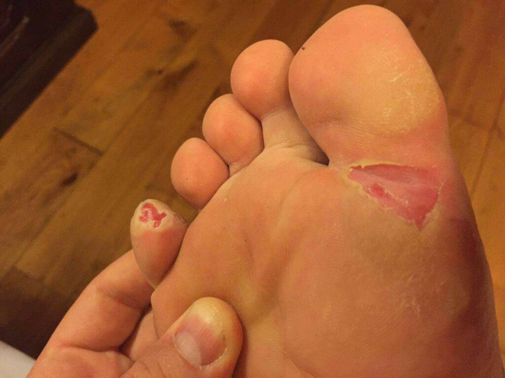 Blister prevention is so important